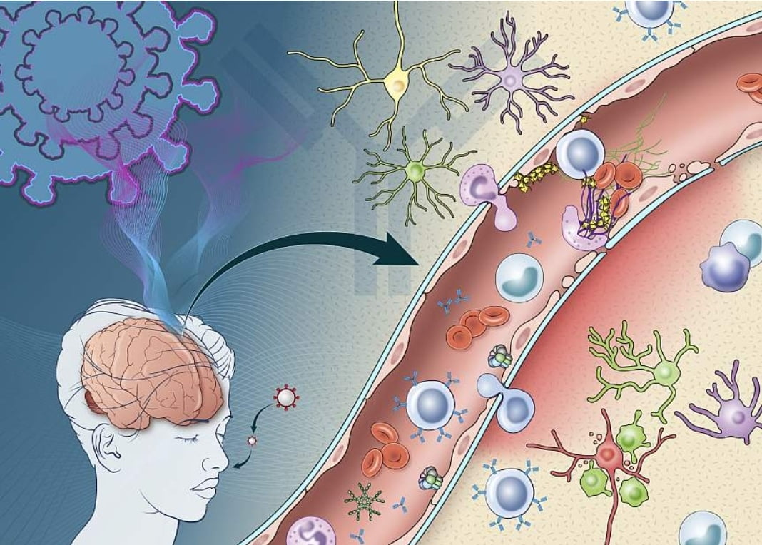 Coronavirusul dă complicațiile grave pe termen lung: Anomalii la creier la 6 luni de la recuperare după COVID (studiu)