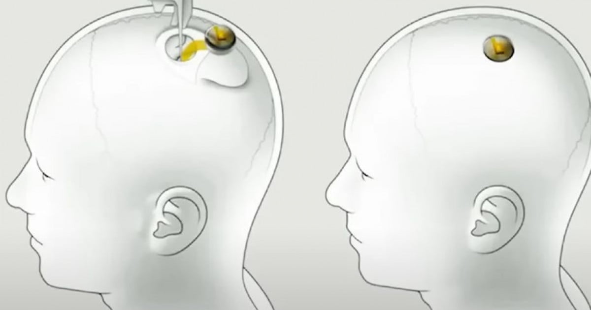 Mii de oameni vor un implant cerebral dezvoltat de compania lui Elon Musk, dar Neuralink nu găsește primul om care să fie testat