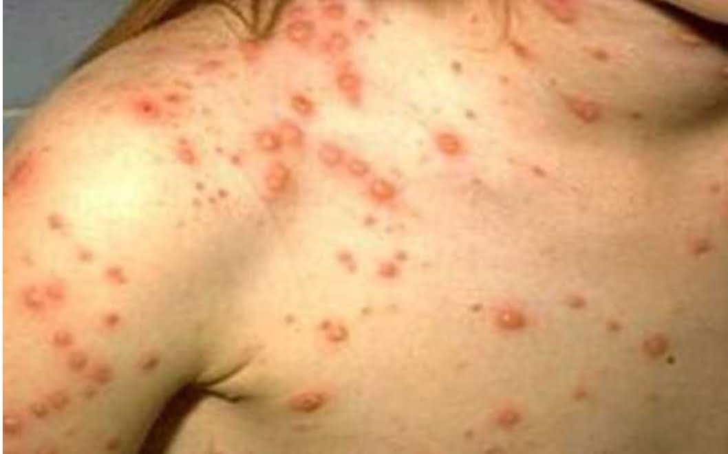 Epidemie de rujeolă! În Prahova sunt 471 de cazuri, dintre care 59 doar în ultima săptămână Epidemie de rujeolă! În Prahova sunt 471 de cazuri, dintre care 59 doar în ultima săptămână