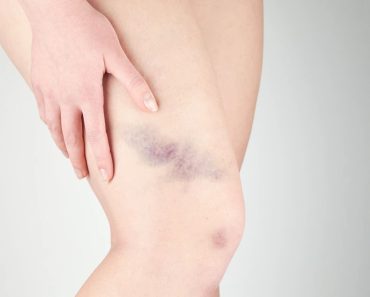 Ce înseamnă culoarea unei vânătăi și când devine un semnal de alarmă pentru sănătate